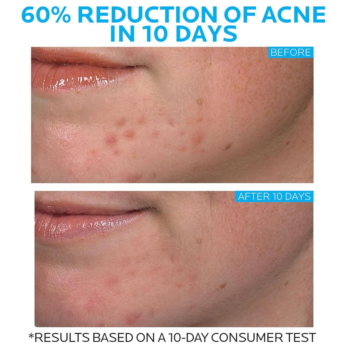 La Roche-Posay Effaclar Duo Dual Action Acne Treatment 20ml,3606000508804