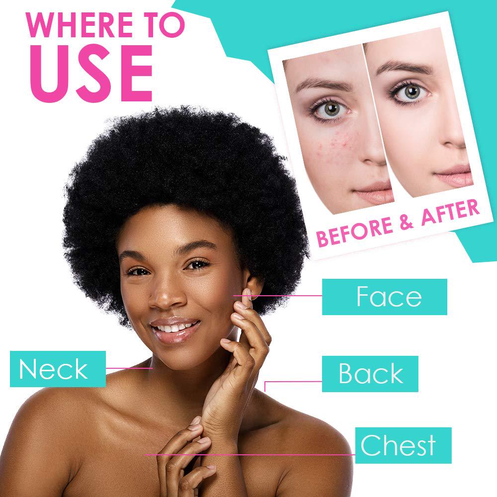 Bye Bye Blemish Acne Drying Lotion, Reduce Pimples Overnight, On-the-Spot Pimple Treatment, Beauty Skincare Essential - 1oz. (3 Pack),