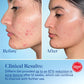 Differin Differin Acne Treatment Gel, 180 Day Supply, Retinoid Treatment For Face With 0.1% Adapalene, Gentle Skin Care For Acne Prone Sensitive Skin, 45g Tube, Pack Of 2 (Packaging May Vary)