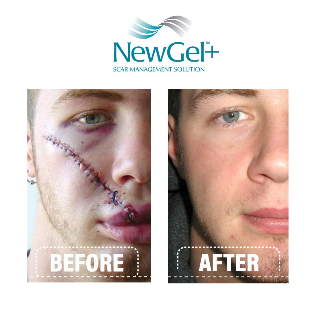 NewGel+E Advanced Silicone Scar Treatment Gel For Old And New Scars W Vitamin E, For Surgery, Injury, Keloids, Burns, And Facial Blemish Scars (15 Grams),