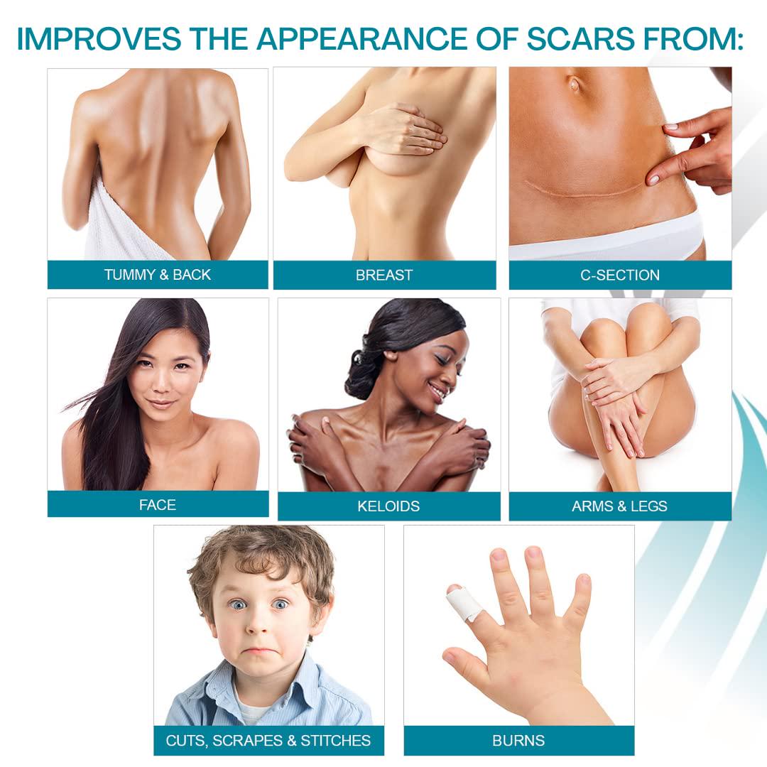 NewGel+E Advanced Silicone Scar Treatment Gel For Old And New Scars W Vitamin E, For Surgery, Injury, Keloids, Burns, And Facial Blemish Scars (15 Grams),